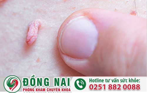 Dấu Hiệu Của Bệnh Sùi Mào Gà