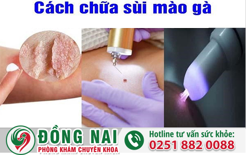 Sùi Mào Gà Ở Vùng Kín - Cách Điều Trị Hiệu Quả
