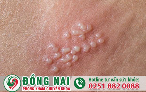 Bật mí mụn thịt dương vật, mụn thịt quy đầu bị bệnh gì?