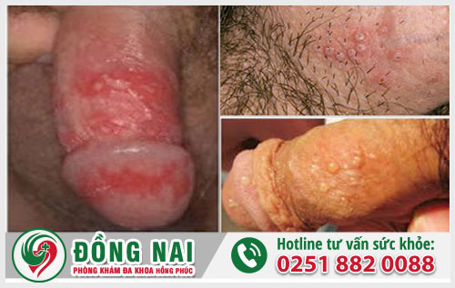 Các bệnh tình dục nguy hiểm thường gặp