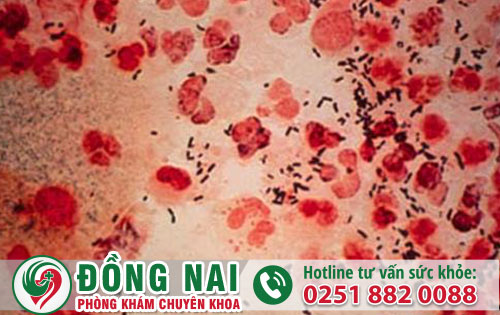 Bệnh lậu mãn tính là như thế nào và có chữa được không?
