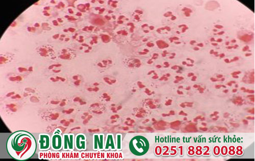 Bệnh Lậu Ở Nam Và Những Điều Cần Biết