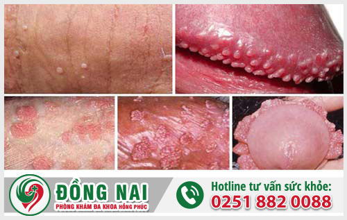 Các bệnh tình dục nguy hiểm thường gặp