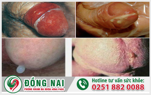 Các bệnh tình dục nguy hiểm thường gặp