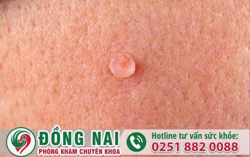 Biểu hiện của sùi mào gà mọc ở âm đạo