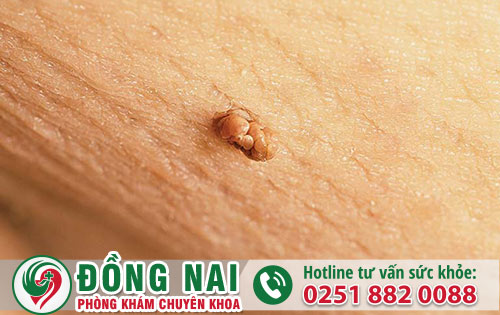 Cẩn Thận Sùi Mào Gà Ở Nam Giới