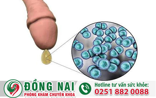 Chẩn đoán đúng bệnh dương vật chảy mủ