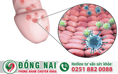 Đầu dương vật nổi mụn là vì sao?