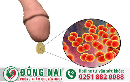 Dấu hiệu bệnh lậu ở nam giới có khó nhận biết?