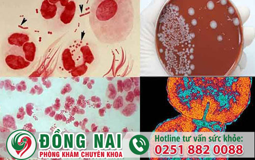 Dấu hiệu nhận biết bệnh Lậu và cách hỗ trợ điều trị hiệu quả
