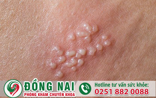 Dấu hiệu nhận biết mụn rộp sinh dục là gì?