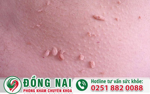 Dấu hiệu sùi mào gà vùng kín nữ và cách hỗ trợ điều trị hiệu quả