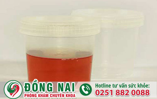 Dấu hiệu tiểu buốt có máu hoặc có mủ ở nữ giới