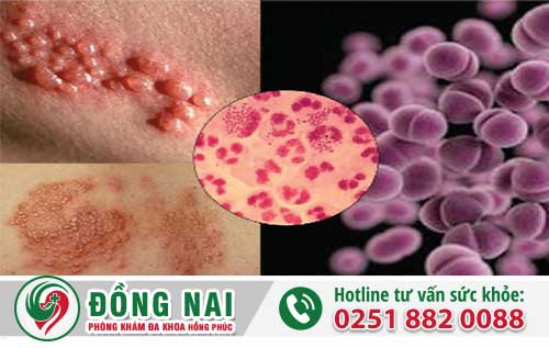 Chữa Bệnh Lậu Bằng Phương Pháp Nào Hiệu Quả Nhất Hiện Nay