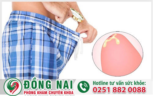 Dương vật chảy mủ - nam giới đang mắc bệnh lậu?