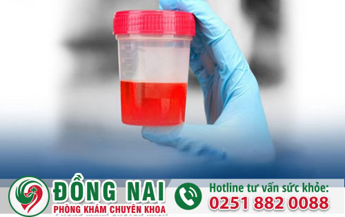 Hỗ trợ điều trị bệnh tiểu ra máu hiệu quả nhất hiện nay