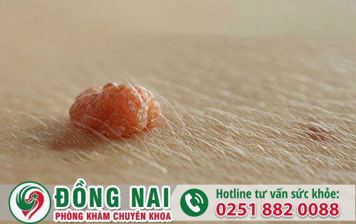 Mụn cóc dương vật là bị bệnh gì?