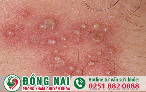 Mụn rộp sinh dục và cách hỗ trợ điều trị hiệu quả