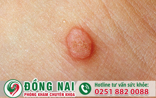 Những nguyên nhân mắc bệnh sùi mào gà