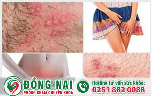 Nổi mụn ở vùng kín triệu chứng không nên bỏ qua