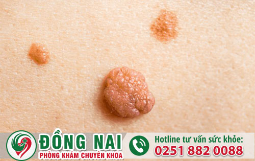 Nổi Mụn Thịt Dư Vùng Kín Có Phải Mắc Sùi Mào Gà