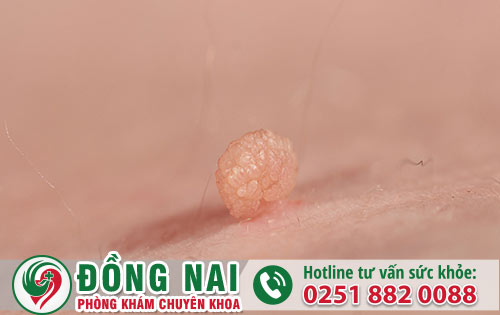 Phương Pháp Điều Trị Mụn Cóc Sinh Dục Hiện Nay Là Gì?