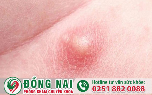 Quy đầu nổi mụn – Đáng lo ngại khi mắc bệnh xã hội