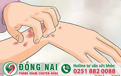 Sùi mào gà có ngứa không?