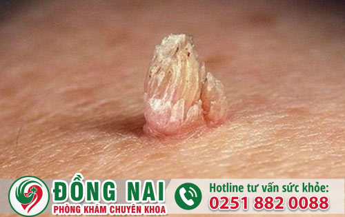 Sùi mào gà nữ giới có biểu hiện như thế nào?