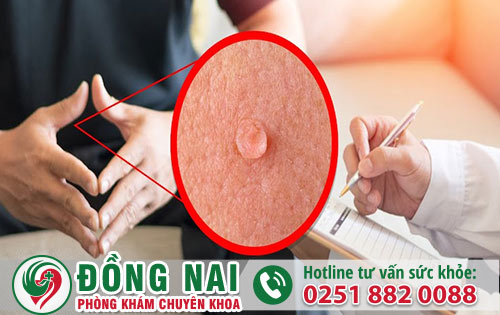 Sùi Mào Gà Ở Nam Giới Nên Nhận Biết Sớm