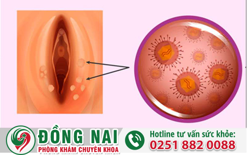 Sùi Mào Gà Ở Nữ Và Dấu Hiệu Cần Biết