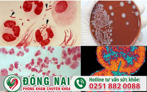 Thời gian ủ bệnh khi nhiễm lậu trong bao lâu?