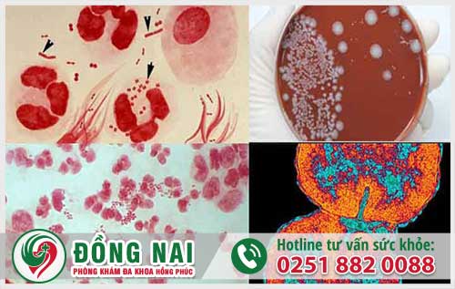 Tiểu đục là căn bệnh nhiễm vi khuẩn lậu dẫn đến