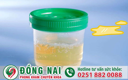 Tiểu Ra Mủ Có Phải Là Bệnh Lậu Không?