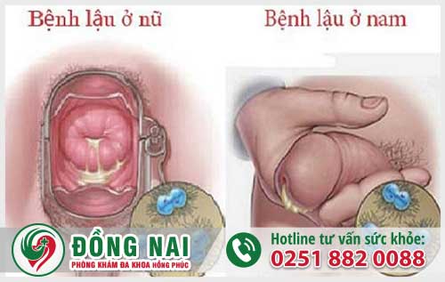 Biểu Hiện Bệnh Lậu Và Những Bất Thường Nào Tìm Hiểu Ngay