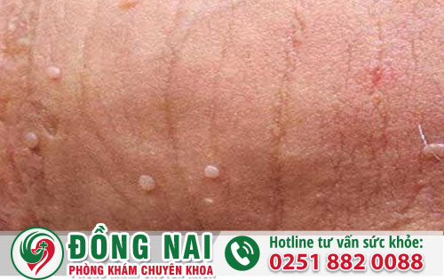 Tình trạng dương vật nổi hạt ở phái mạnh