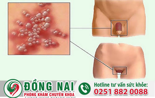 Tình Trạng Mọc Mụn Vùng Lông Mu Ở Nam Và Nữ Giới